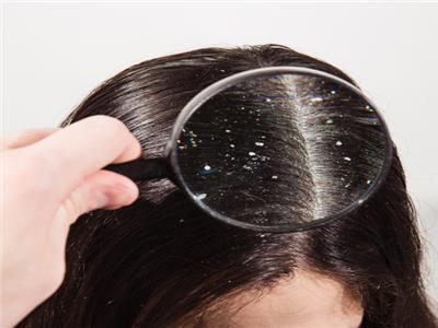 قشرة الشعر قد تكون دليلا على مرض عصبي خطير