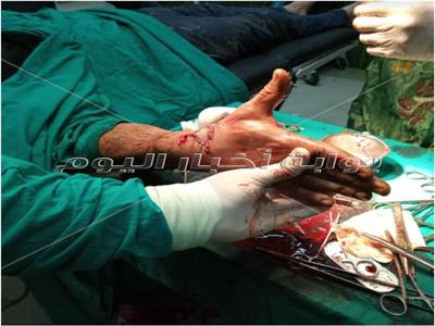 إجراء جراحة ناجحة لمريض بمستشفى الدلنجات المركزى لتثبيت ٥ اوتار باليد اليمنى