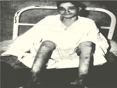 آثار التعذيب على جسد قوت عبدالجليل