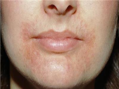 نصائح للسيطرة على التهاب الجلد حول الفم | بوابة أخبار اليوم الإلكترونية