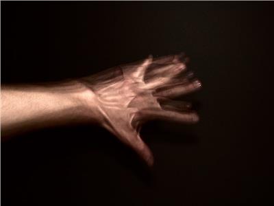 اليد الغريبة مرض متلازمة اليد