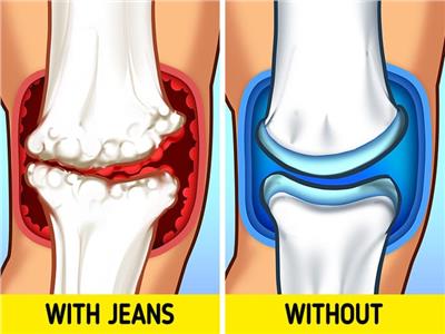 3 أضرار جسدية يسببها ارتداء الجينز لفترات طويلة
