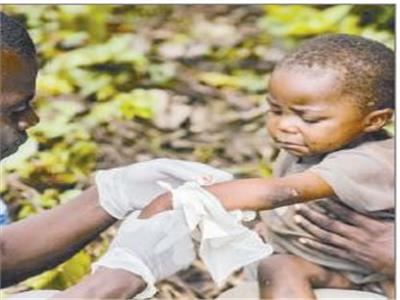 طفل مصاب بجدرى القرود يتلقي العلاج فى جمهورية إفريقيا الوسطى «صورة من أ ف ب»