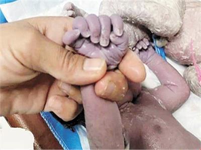 ولادة نادرة لطفلة بـ24 إصبعاً