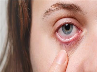 علامات تحذيرية لارتفاع نسبة الكولسترول في عينيك
