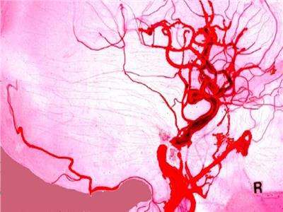 تمدد الأوعية الدموية