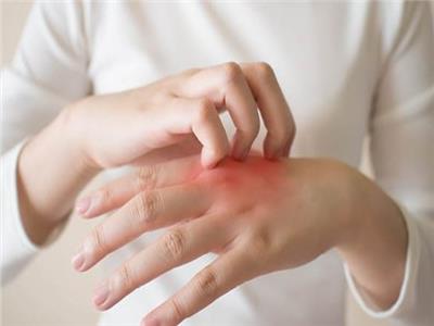 علاجات منزلية للعدوى الفطرية