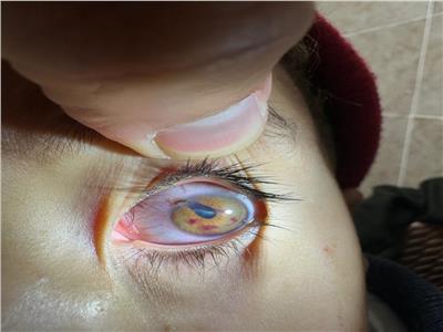 بسبب «بمب العيد».. إصابة 50 طفلًا بانفجار مقلة العين في سوهاج