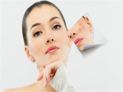 علاجات طبيعية لعلاج أثار حب الشباب