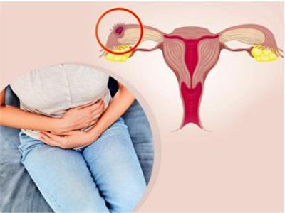 أسباب الحمل خارج الرحم ومخاطره على صحة الأم والجنين