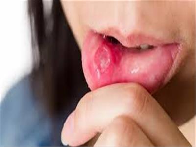 علاج قرح الفم منزليا
