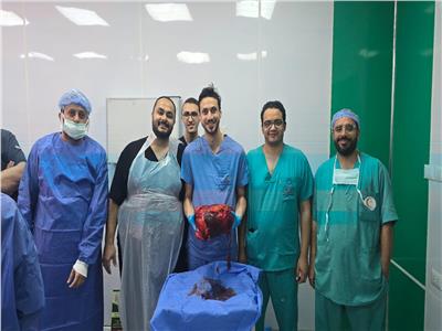  استئصال ورم نادر يزن أكثر من 30 كيلو جرامًا من بطن مريض شاب