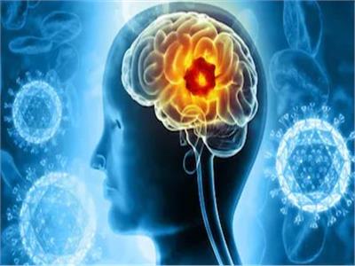 عندما يخدعك التوتر.. أعراض قد تخفي ورمًا في الدماغ