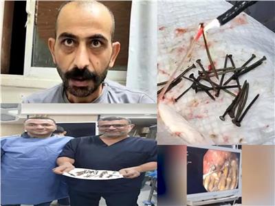مريض بني سويف بعد استخراج 119 مسمار وصامولة من معدته