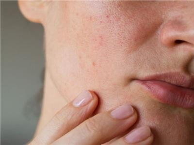 انتفاخ الوجه في الصباح