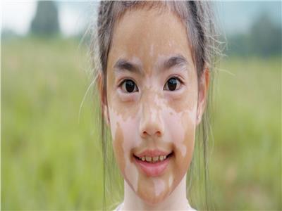 البهاق عند الأطفال