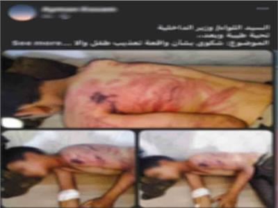 تعذيب طفل وإصابته في المنوفية