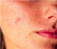 أسباب ظهور «الحبوب الملتهبة» في الوجه.. وطرق علاجها