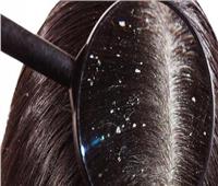 كيف تحمي شعرك من القشرة في فصل الشتاء؟