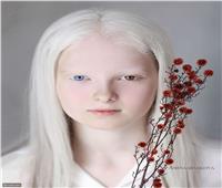 هيتروكروميا.. خلل جيني نادر يمنح طفلة روسية جمالاً استثنائيًا 