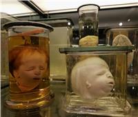 متحف فروليك.. رعب داخل أجساد الأجنة| صور