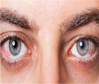 هل نقص هذا الفيتامين يؤدي للإصابة بالعمى الليلي؟.. أستاذ جراحة عيون يجيب