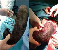 بعد اجراء عملية جراحية.. شاهد ما وجده الأطباء في معدة فتاة لبنانية 