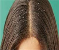 هاني الناظر يكشف أسباب قشرة الشعر وطرق علاجها| فيديو