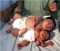 أغرب 5 حالات ولادة عالمياً.. أشهرهم طفل يولد في مرحاض قطار| صور