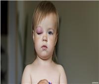 تعرف على أعراض المتلازمة الكلوية لدى الأطفال وكيفية علاجها