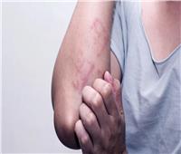 ولاية جوهور الماليزية تسجل 7 آلاف إصابة بمرض جلدي
