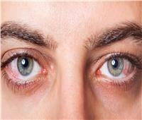 هل جفاف العين يسبب العمى؟