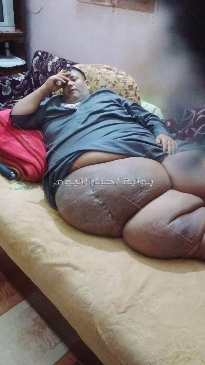 مأساة شاب بالغربية  يعاني من السمنة المفرطة 360 كيلو