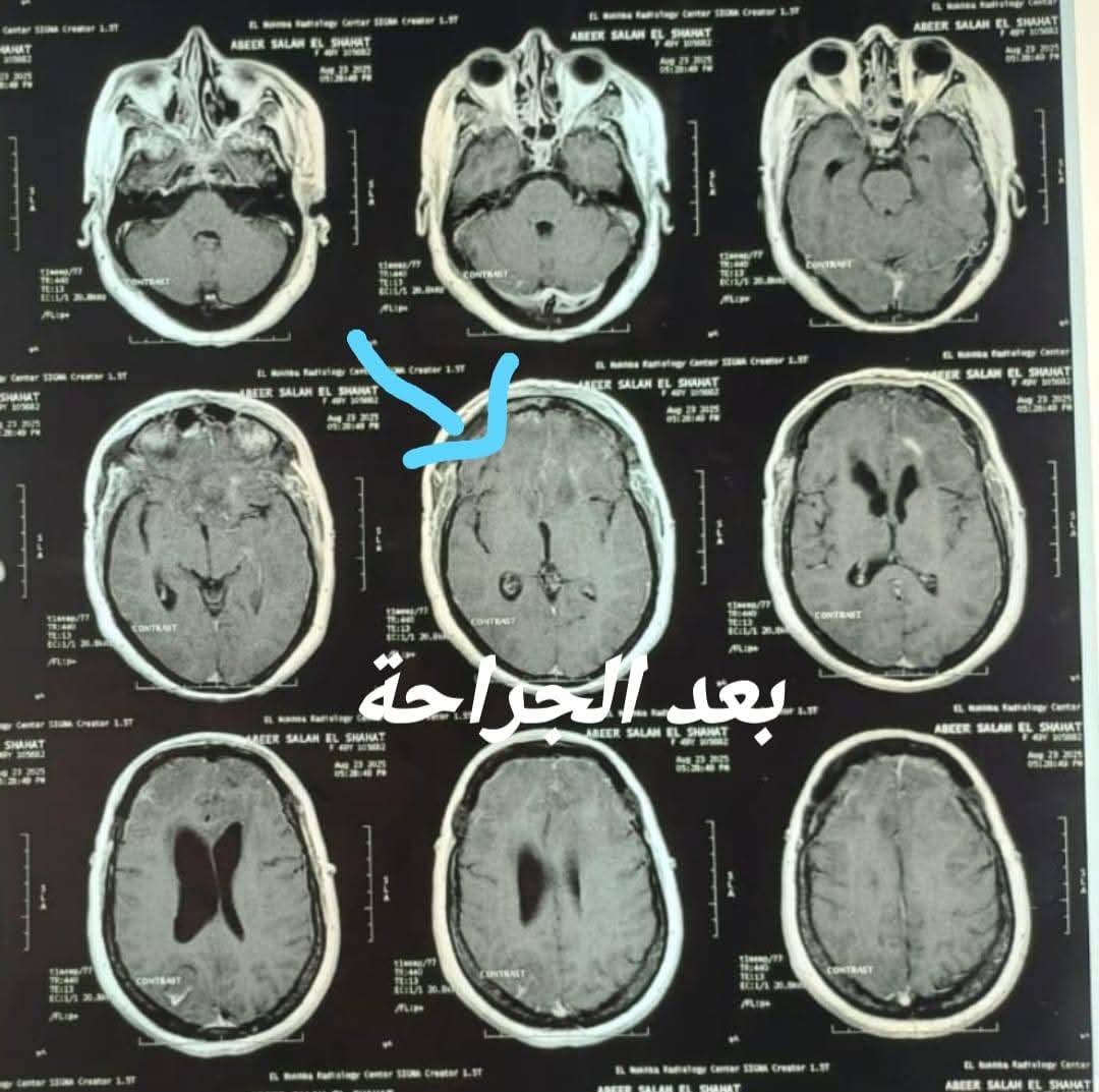 فريق طبى بجامعة المنوفية يستأصل ورم بقاع الجمجمة لمريضة واستعادتها للوعي الكامل| صور