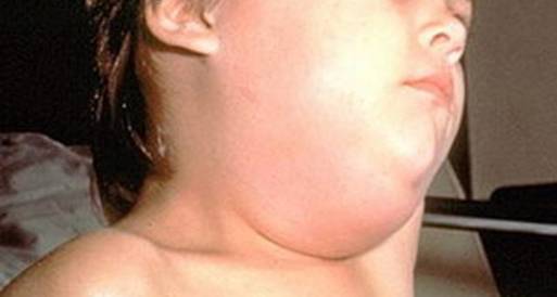 انحسار مرض الغدة النكافية بالشرقية
