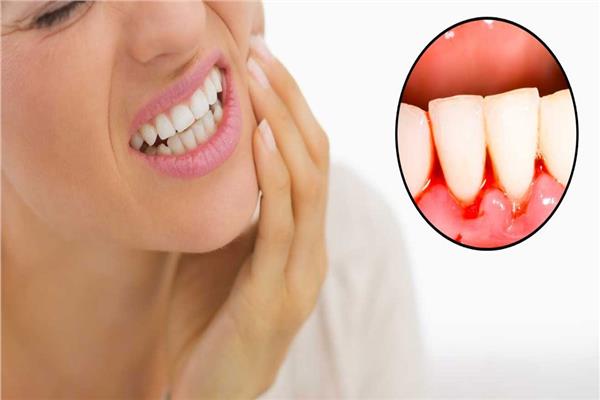 علاج نزيف اللثة
