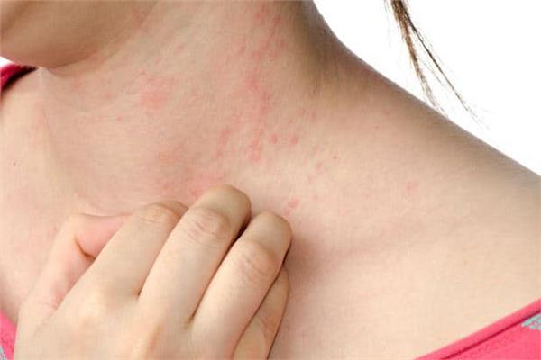 مصروف الجار الى الآن علاج حساسية الجلد بسبب الأدوية Comertinsaat Com