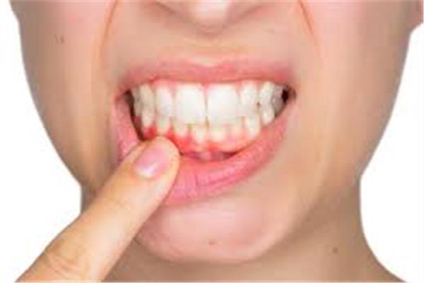 تعرفي على .. أبرز أسباب الإصابة بنزيف اللثة
