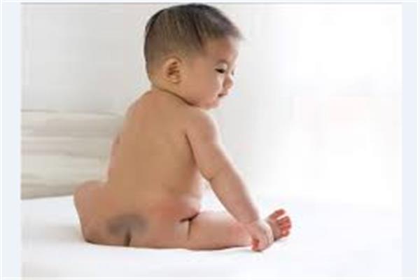 البقعة المنغولية عند الأطفال حديثي الولادة ، تعرف على أسبابها وطرق علاجها