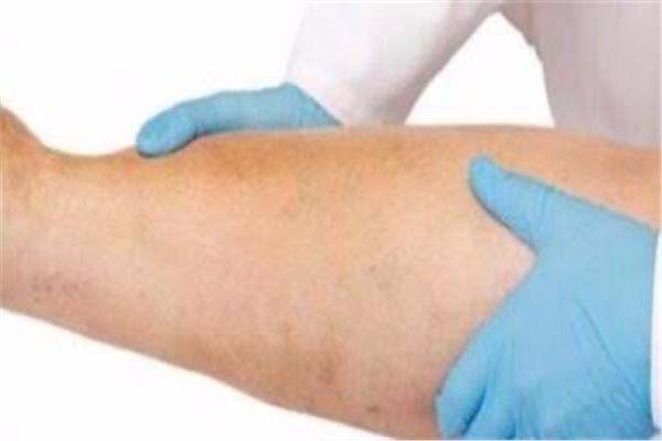  علاج دوالي الساقين بالتردد الحراري  