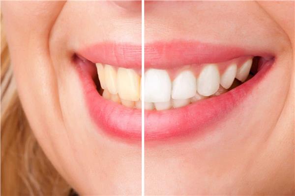 7 طرق تساعدك على تبييض أسنانك