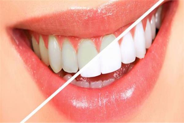معلومات عن تبييض لأسنان في المنزل
