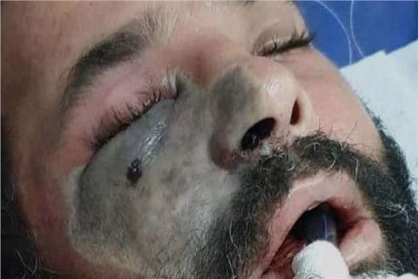 الفطر الأسود 