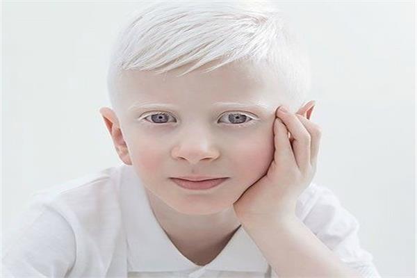 طفل مريض بالمهق