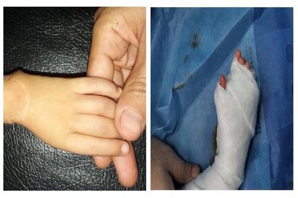 جراحة نادرة .. بجامعة طنطا  تحويل السبابة إلي إبهام باليد اليسري لطفل عمره عامين