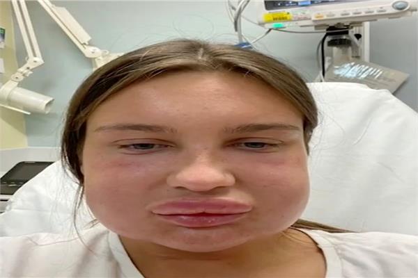 انتفخت شفاه سيدة بعد ذوبان الفيلر