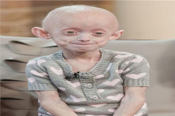 من شيخوخة الأطفال الي متلازمة ستونمان ..اغرب الأمراض حول العالم