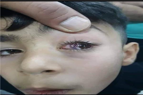 طفل يفقد عينه اليسرى بسبب خرزة 