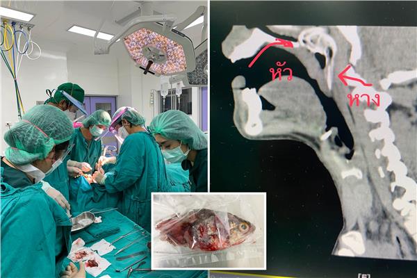 صياد يخضع لعملية جراحية بعد قفز سمكة من الماء إلى حلقه 