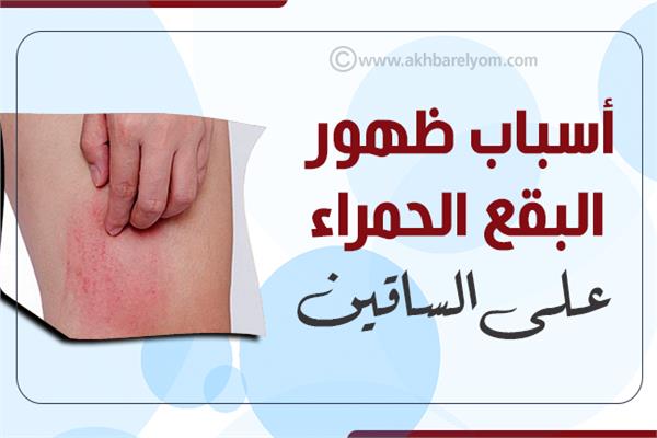 إنفوجراف| أسباب ظهور البقع الحمراء على الساقين